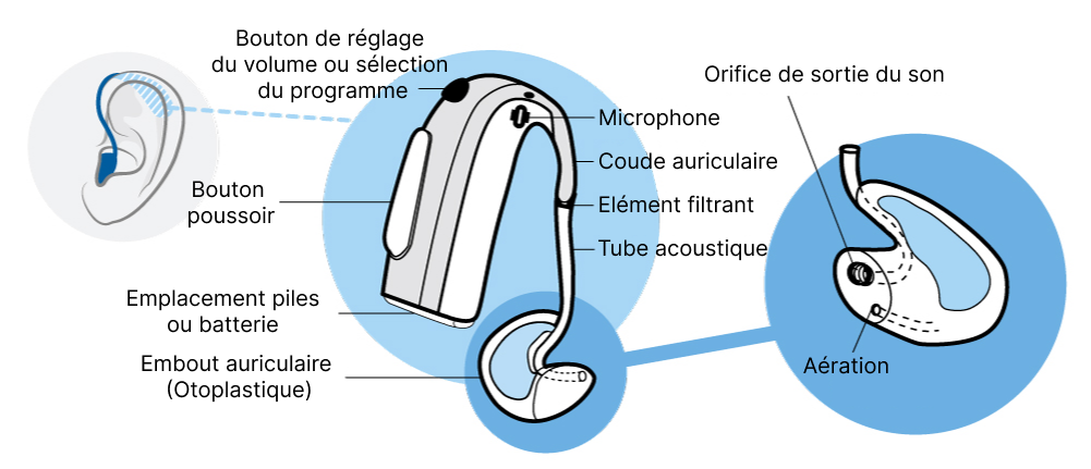 Appareils Auditifs Contours D Oreille Audibene